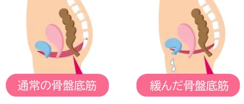 通常の骨盤底筋と緩んだ骨盤底筋